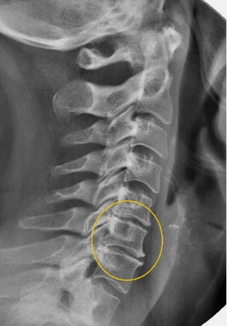 Osteocondrosis de la columna cervical en una raya x